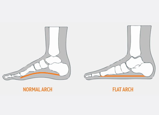 Flat feet need stability running footwear: Truth or myth?