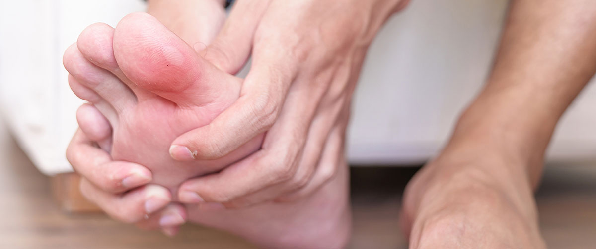 Heel and toe blisters when running